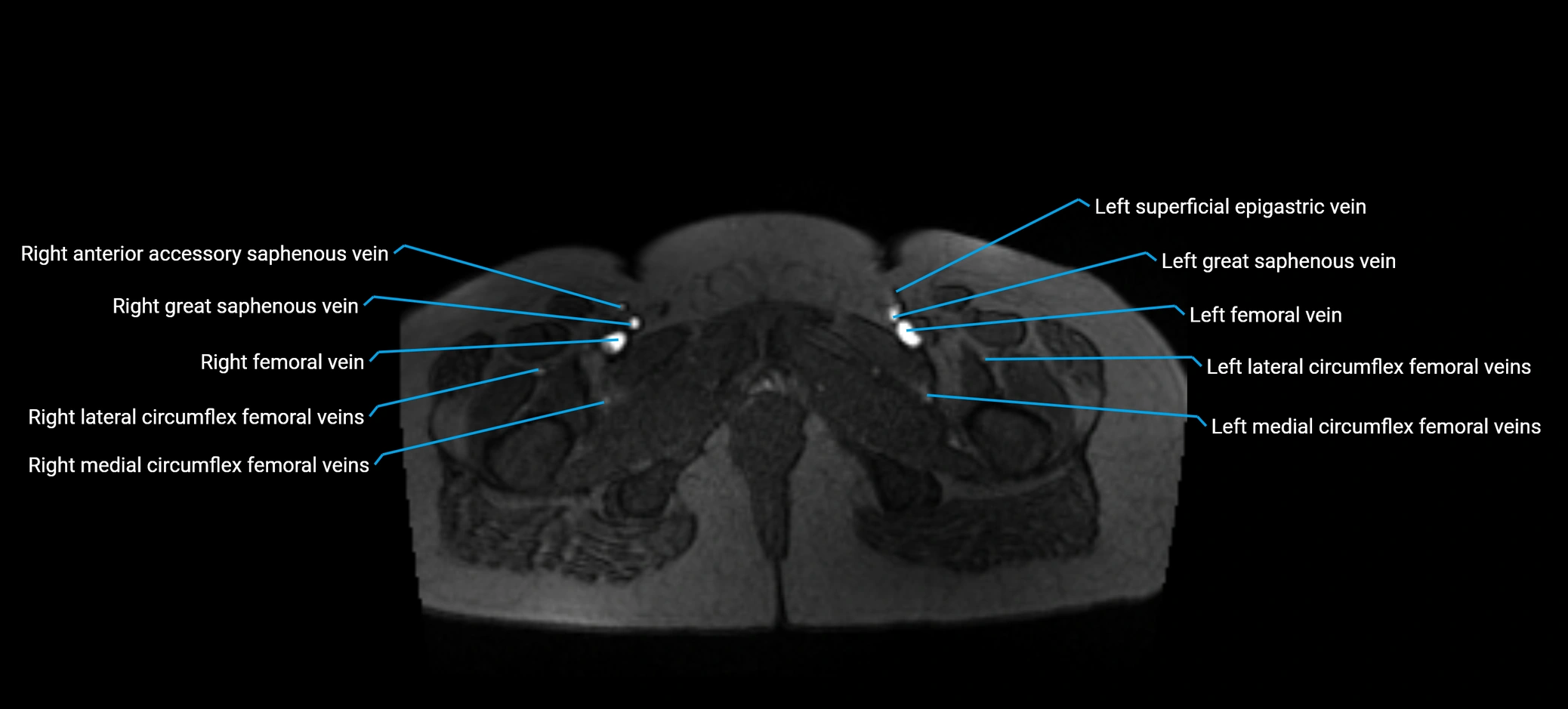 MRV abdomen pelvis & lower limb axial cross sectional anatomy labelled MRI image 197 (1).webp